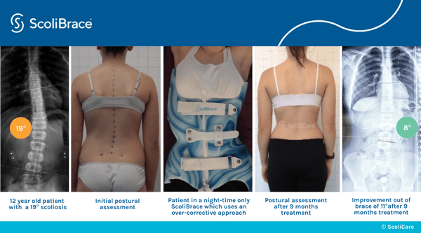 8 - Correction of a moderate thoracolumbar scoliosis using a ScoliNight orthosis 8 - Correction of a moderate thoracolumbar scoliosis using a ScoliNight orthosis