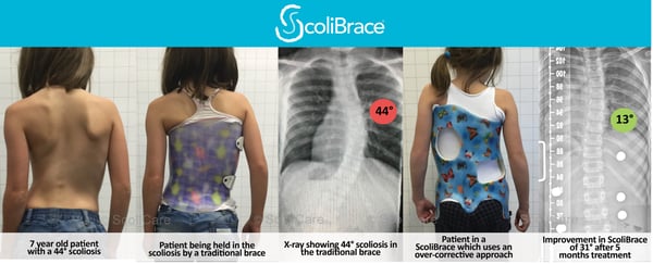 Case 5 - ScoliBrace-1