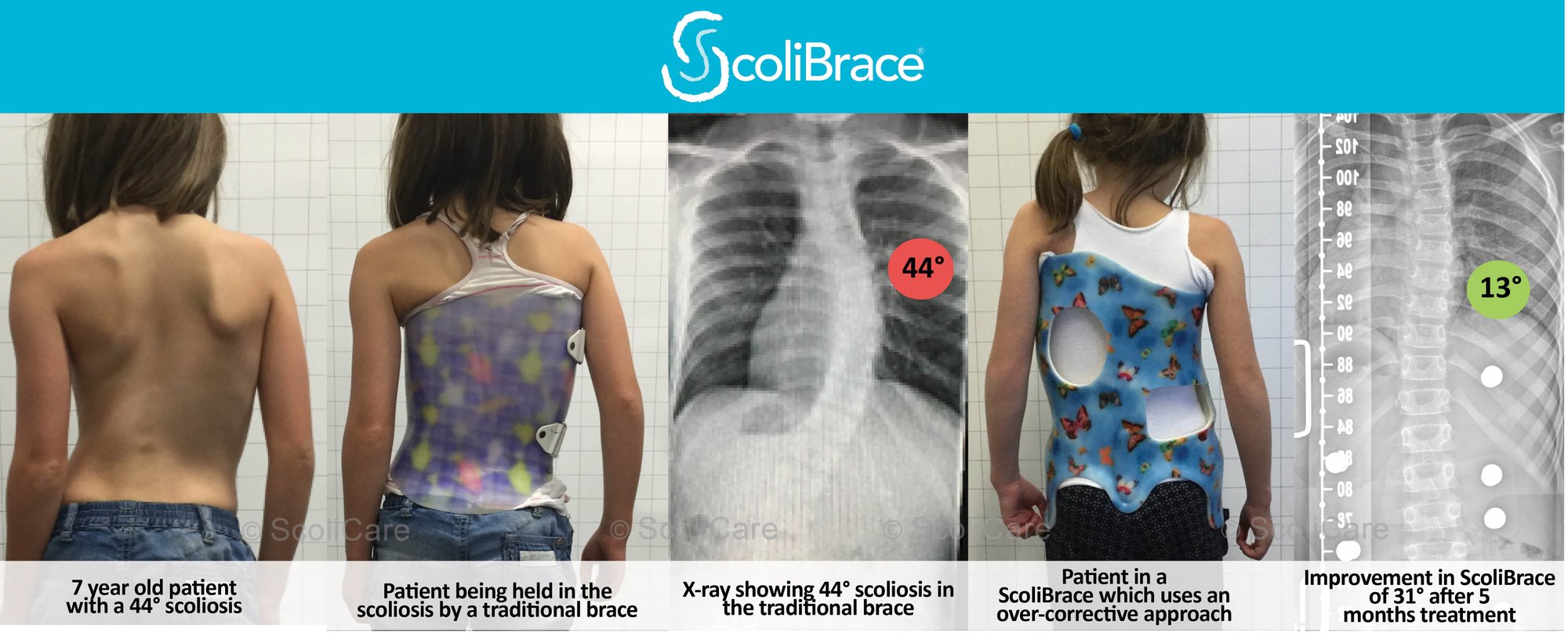 Case 5 - ScoliBrace-1 Case 5 - ScoliBrace-1
