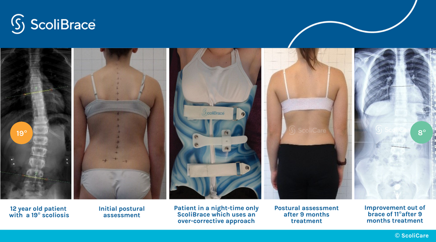 8-correction-of-a-moderate-thoracolumbar-scoliosis-using-a-scolinight-orthosis-1