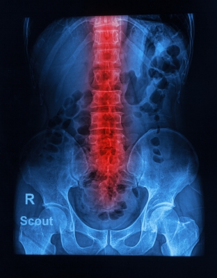 Spinal xray