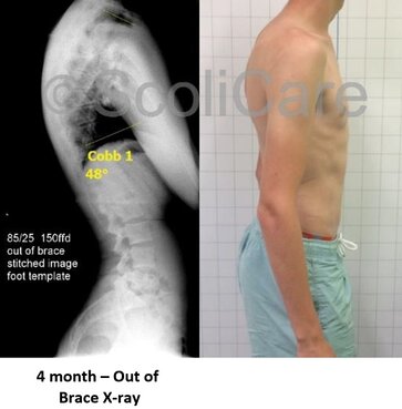 Patient Posture Improve_Spinecare ChiropracticPicture