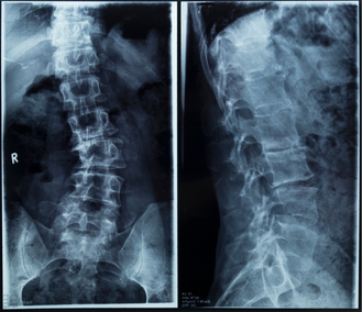 Scoliosis_Spinecare Chiropractic
