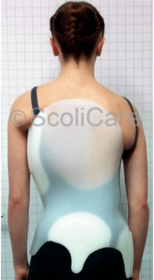 Patient Wearing Scolibrace_Spinecare Chiropractic
