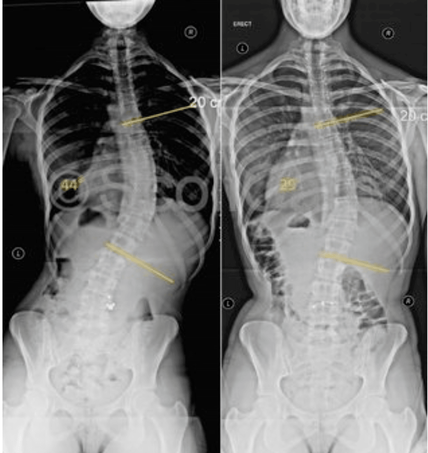Scoliosis X-Ray Before and After_Spinecare ChiropracticPicture