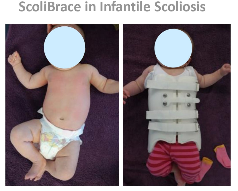 Scolibrace in Infantile Scoliosis_Spinecare Chiropractic