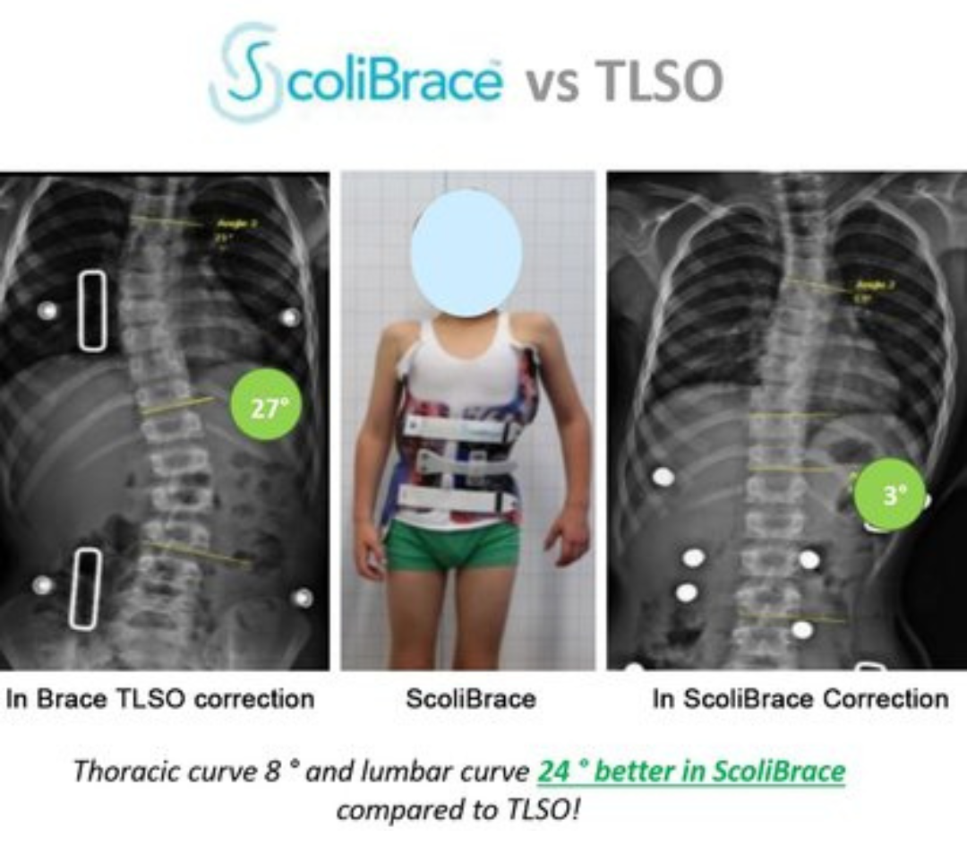 Scolibrace vs TLSO_Spinecare ChiropracticPicture