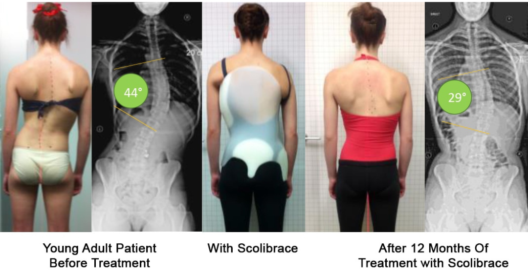 Results After Using Scolibrace_Spinecare ChiropracticPicture