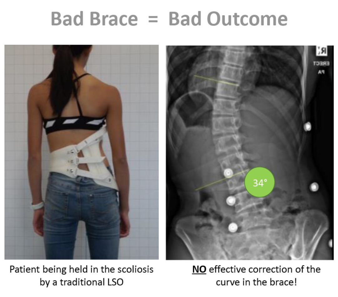 Bad Brace = Bad Outcome_Spinecare Chiropractic