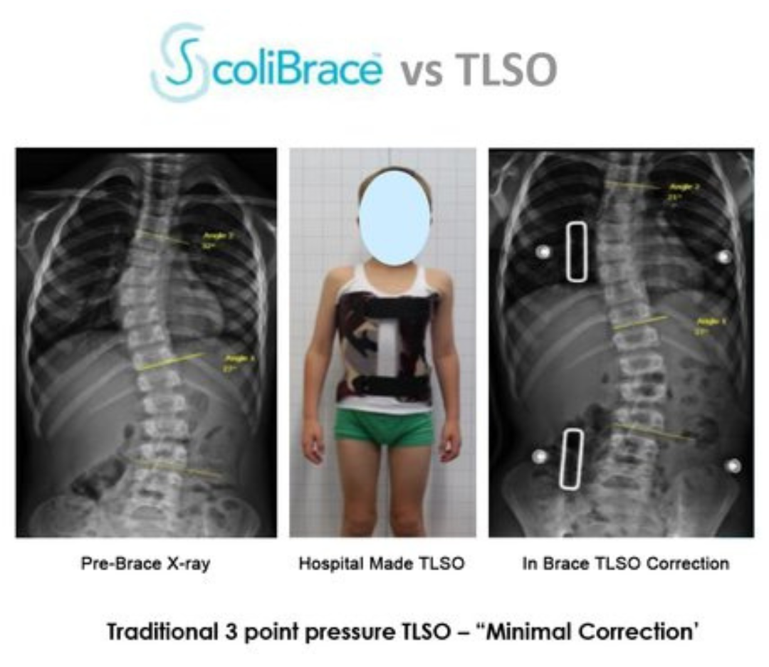 Traditional 3 Point Pressure TLSO_Spinecare ChiropracticPicture
