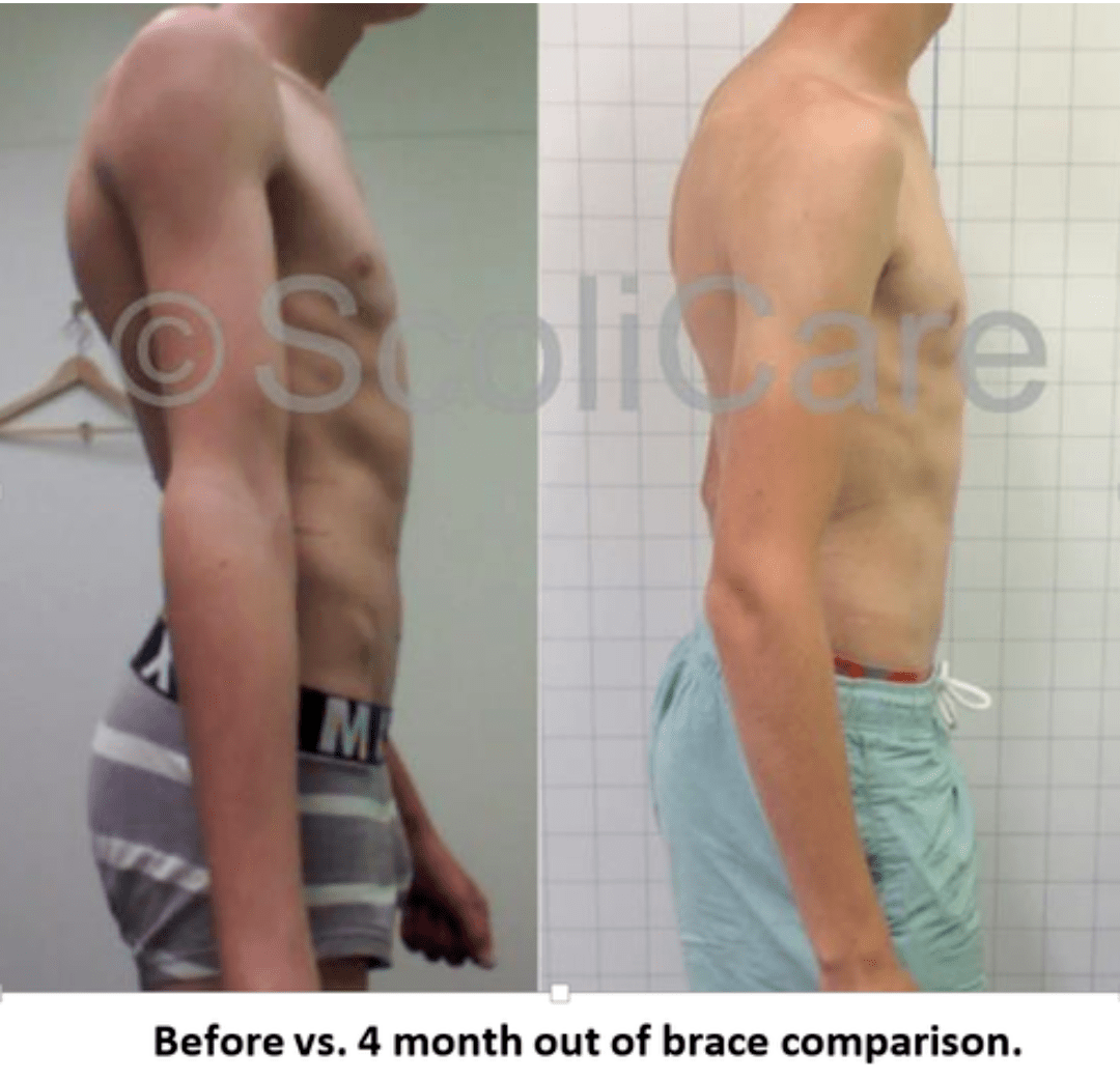Before VS After Out Of Brace_Spinecare ChiropracticPicture