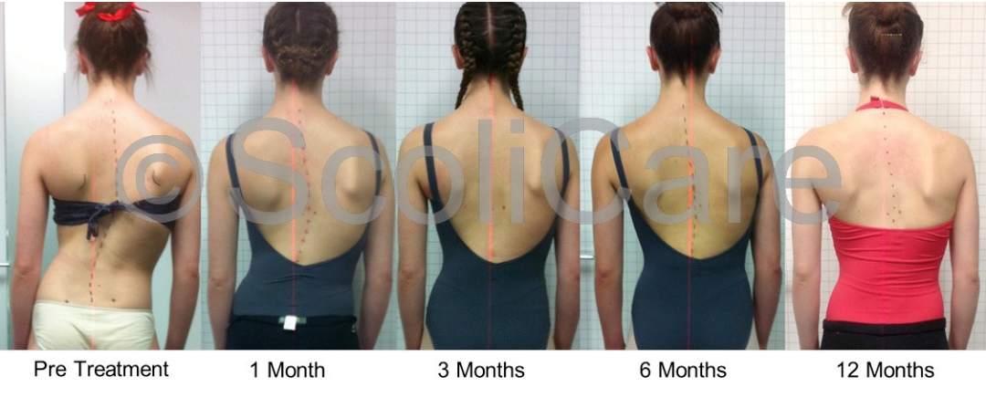 Scolibrace Affects After 12 Months_Spinecare Chiropractic