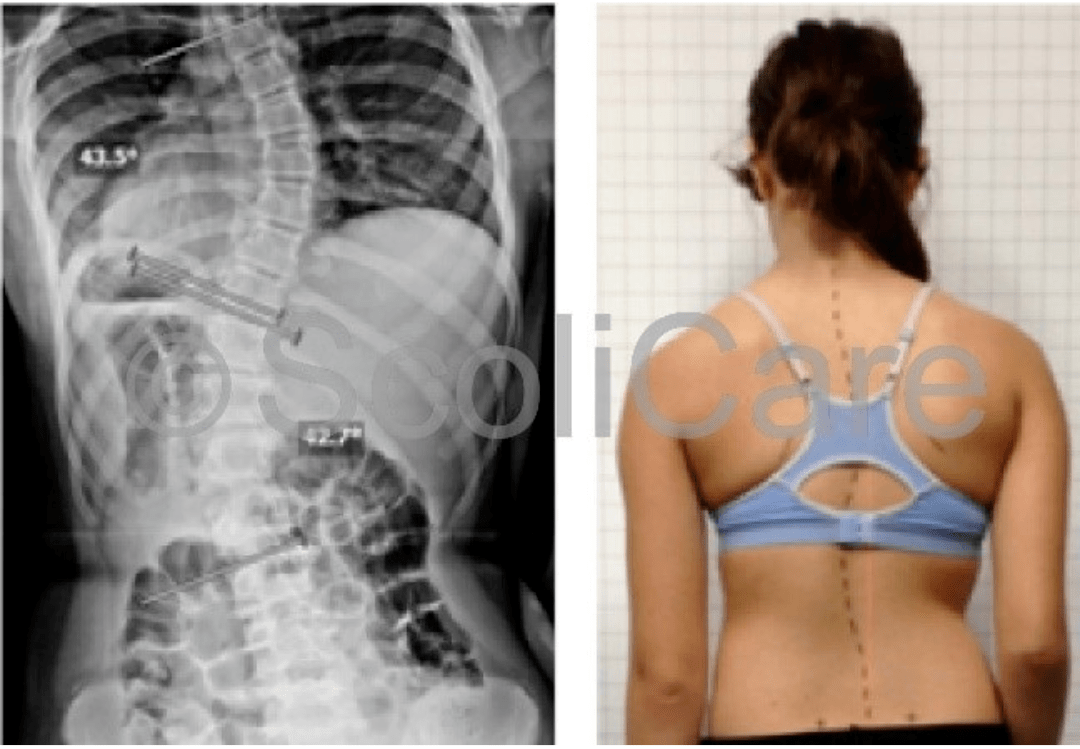 Patient Before Scoliosis Treatment_Spinecare ChiropracticPicture