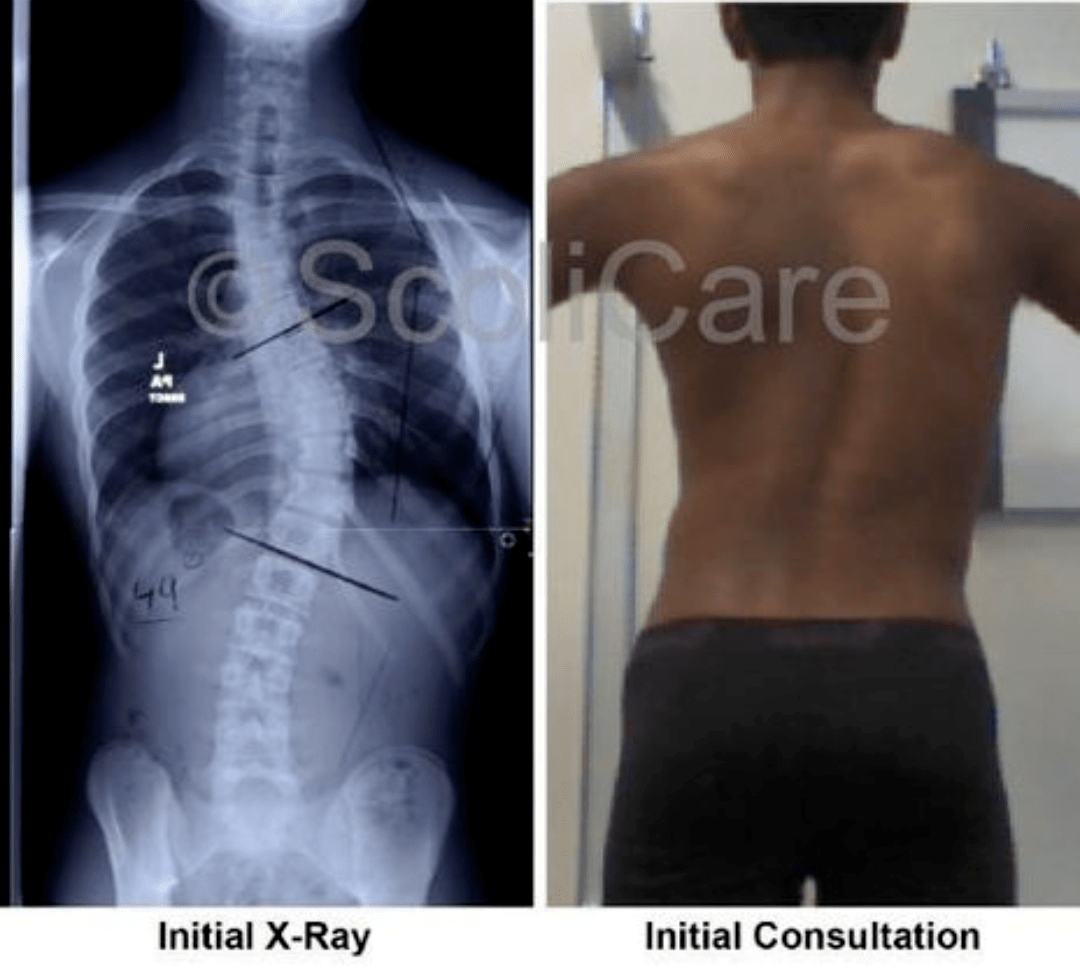 Initial Condition Patient_Spinecare Chiropractic